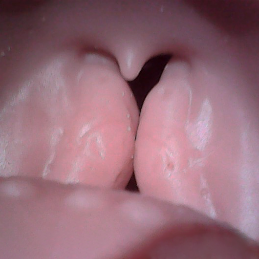 AirwayChild Replaceable Soft Airway 3 - Swollen Tonsils & Epiglottis