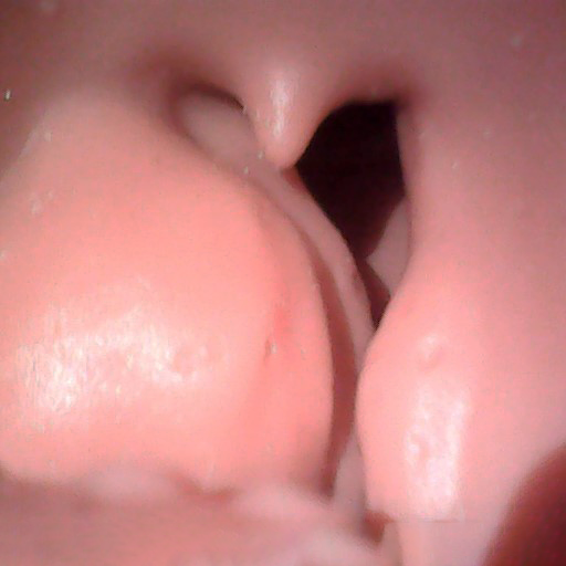 AirwayChild Replaceable Soft Airway 4 - Peritonsillar Abscess