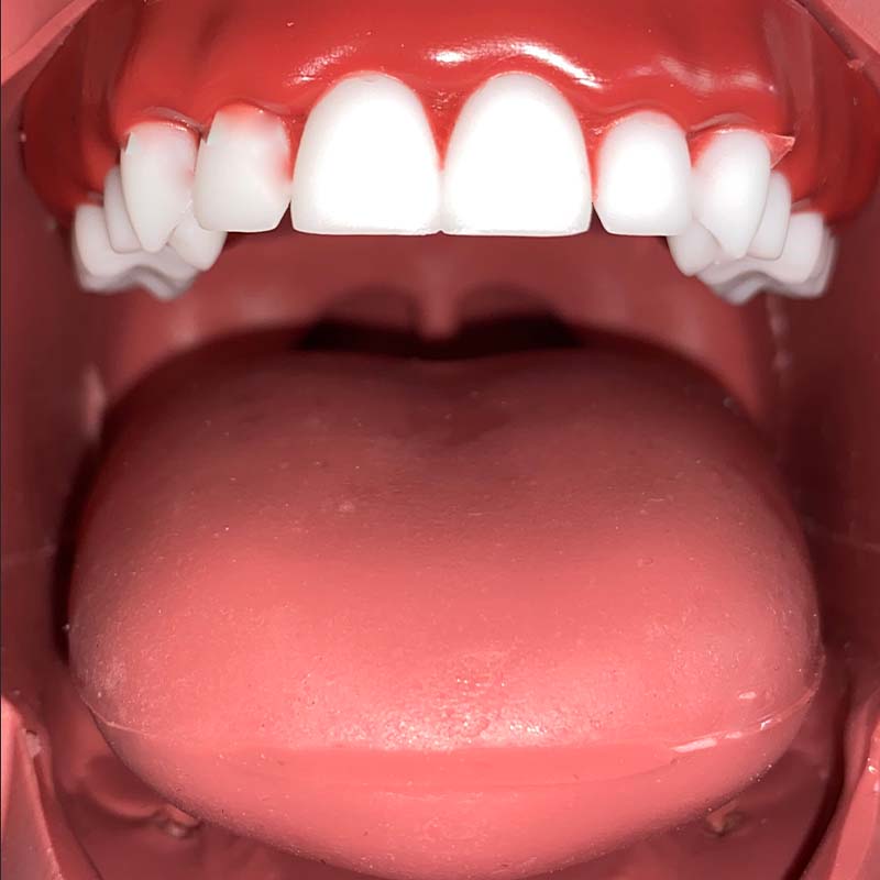 AirwayMan Replaceable Difficult Soft Airway 1 (Swollen Tongue)