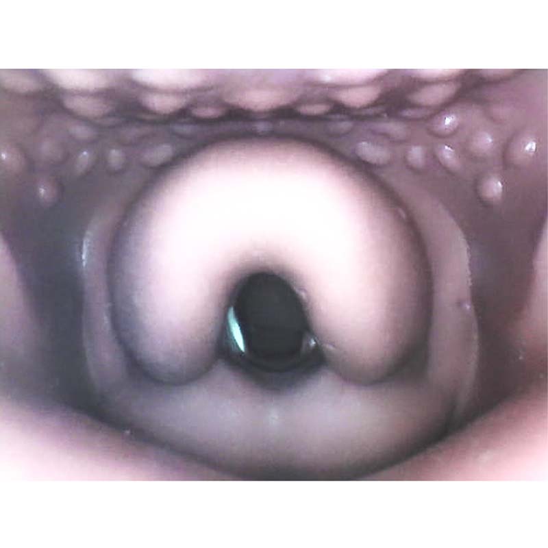 AirwayMan Replaceable Difficult Soft Airway II (Blocked)