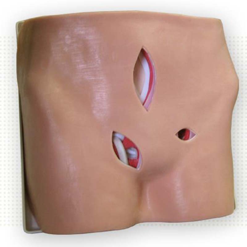 Hernia Model