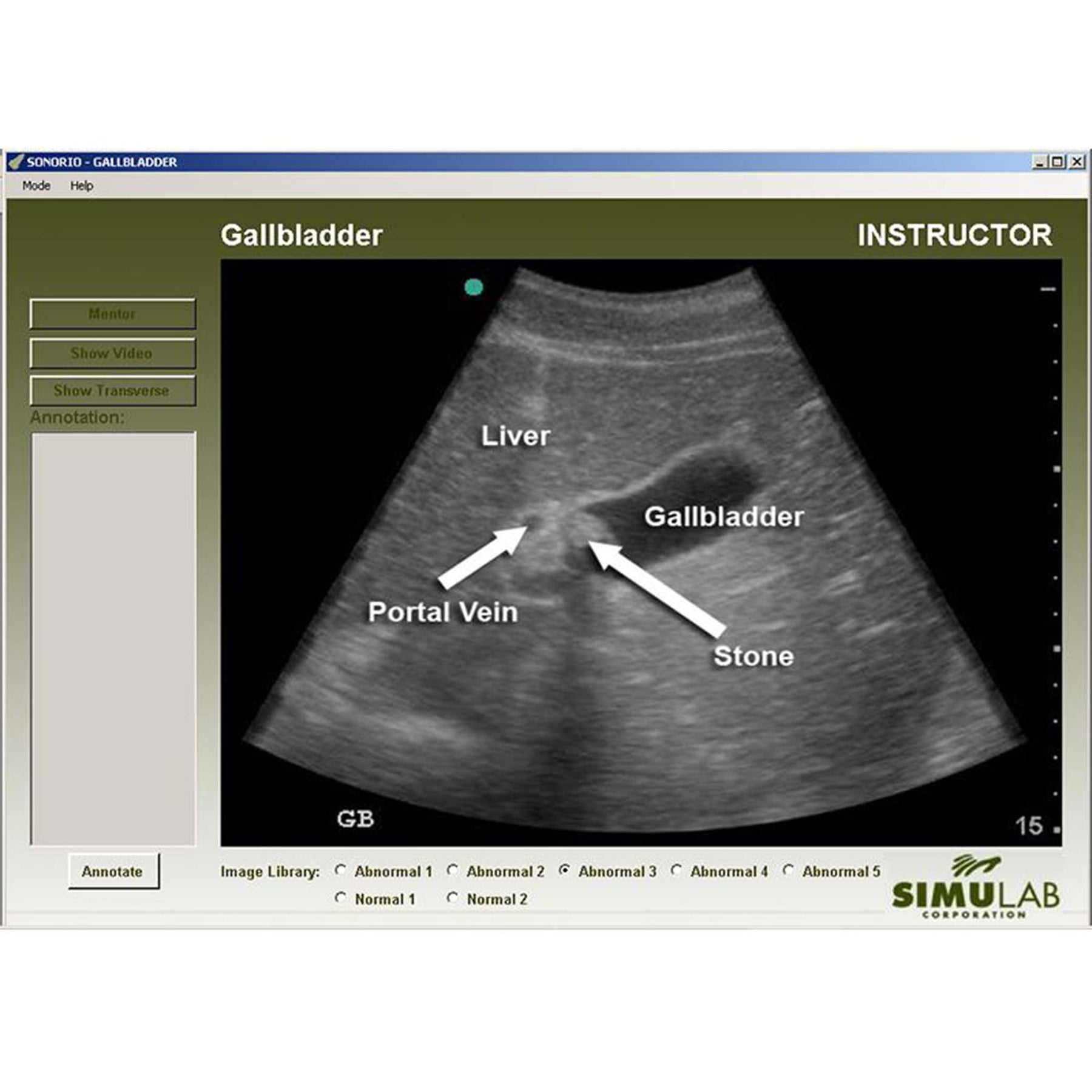gallbladder ultrasound transverse